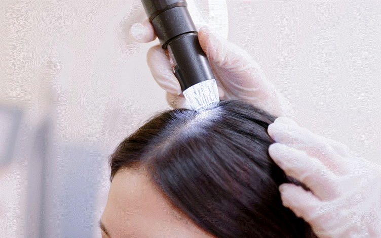 Pregnancy Hair Loss: Myths, Facts, and Practical Solutions