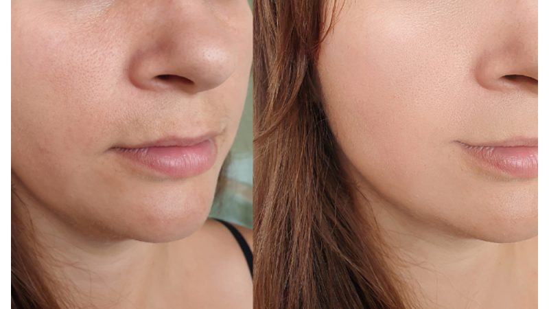 Trending Plastic Surgery Procedures in Singapore