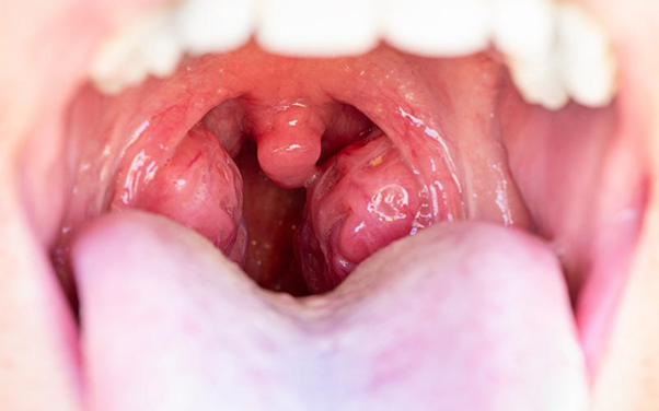 How ENT Specialists in Singapore Treat Chronic Tonsillitis and Tonsil Stones