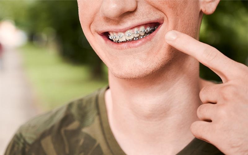 Finding the Balance Between Cost and Care: Affordable Braces in Singapore