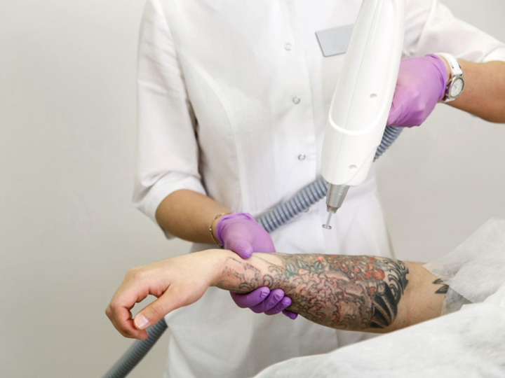 Why the Pico Laser Is a Popular Choice for Tattoo Removal