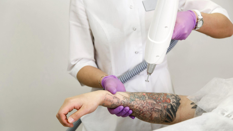 Why the Pico Laser Is a Popular Choice for Tattoo Removal