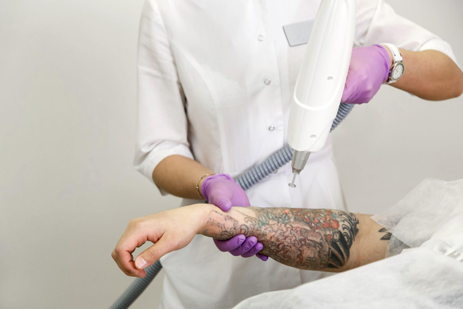 Why the Pico Laser Is a Popular Choice for Tattoo Removal