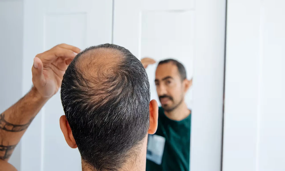 Male Hair Loss and the Treatment That Actually Has Evidence Behind It