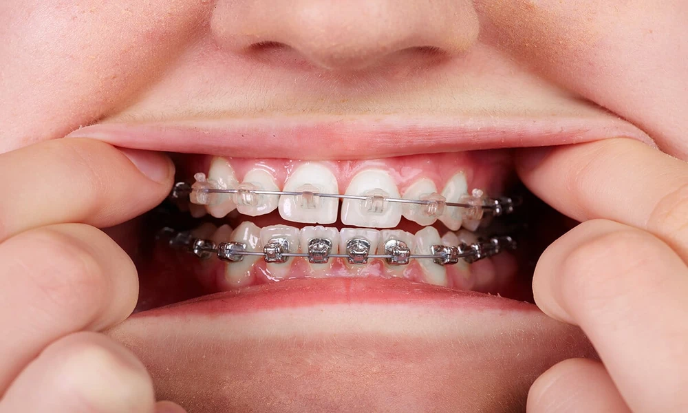 How to Choose Between Clear Braces and Metal Braces for Teenagers